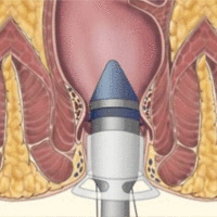 Геморрой: лечение внутреннего и внешнего геморроя у мужчин и женщин в Москве